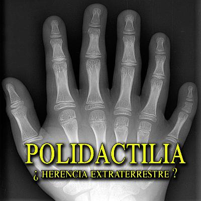 ¿Polidactilia Herencia Extraterrestre? Una rara condición de tener 6 dedos en pies y manos