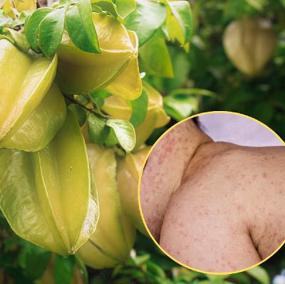 Bé 10 ngày tuổi nổi mụn mủ li ti vì tắm bằng nước lá khế