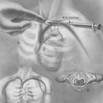 Direto na veia Parte I Direto na veia Parte I