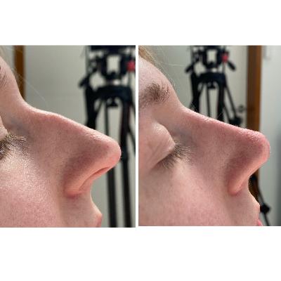Nasenkorrektur ohne OP -Schönheitschirurgie Mc Aesthetics Nasenkorrektur ohne OP -Schönheitschirurgie Mc Aesthetics