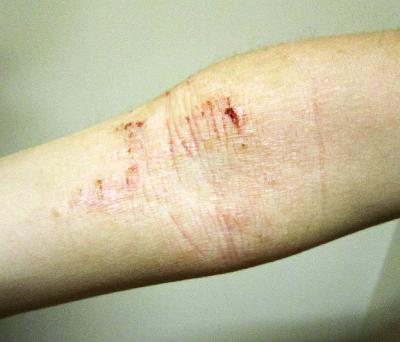 Dermatite atopica più comune nei neonati e nei bambini