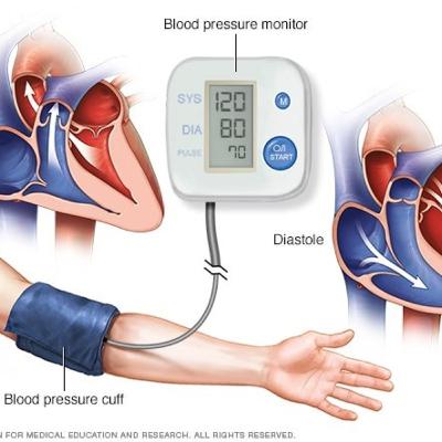Hipertensión Arterial