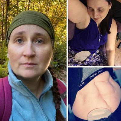 Episode 22: Katie Vyn, Ulcerative Colitis and the Beautiful Journey of Life