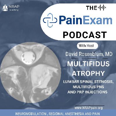Multifidus Atrophy, Spinal Stenosis, PNS and PRP Injections!