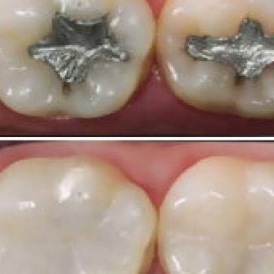 Materiais restauradores definitivos/ Dentística I Materiais restauradores definitivos/ Dentística I