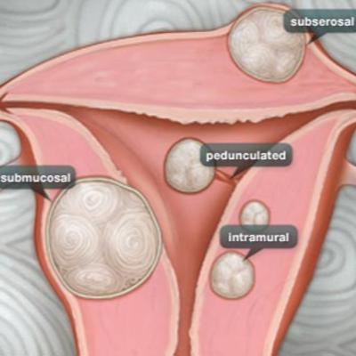 So, I've Got Fibroids...Now What?