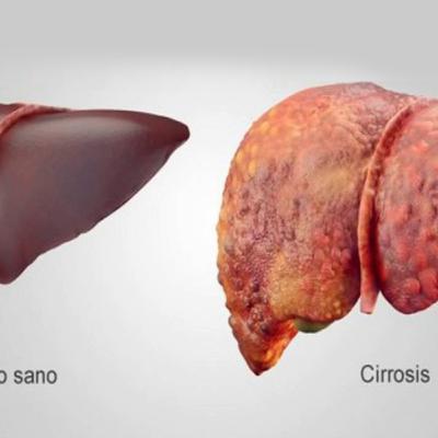 Cuidado nutricional en la cirrosis hepática Cuidado nutricional en la cirrosis hepática