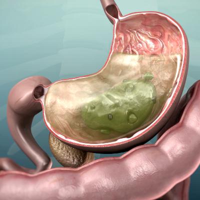 A Grandma Collapsed From Abdominal Pain. This Is What Happened To Her Colon.