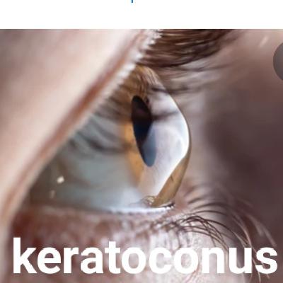 Decision making in Keratoconus