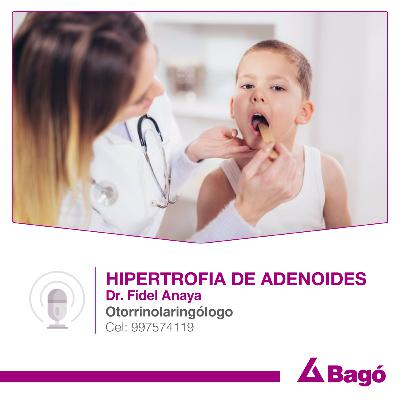 HIPERTROFIA DE ADENOIDES