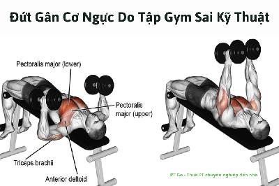 Đứt gân cơ ngực do tập gym sai kỹ thuật Đứt gân cơ ngực do tập gym sai kỹ thuật