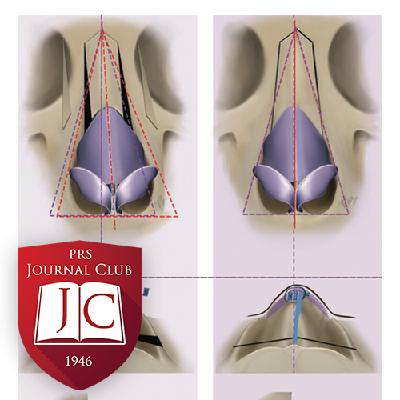 "External Strip and Internal Spreader Graft" with Gabriel Del Corral, MD - Nov. 2025 Journal Club