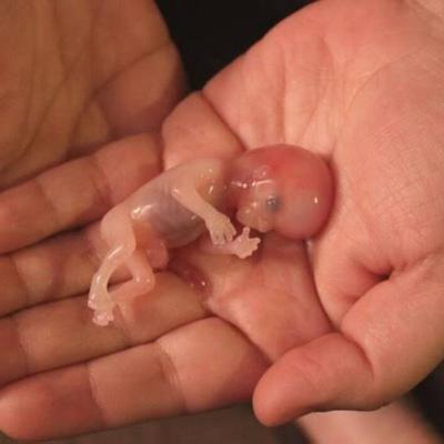 abortion