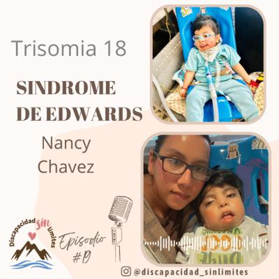 19. Sindrome de Edwards, Trisomia 18 con Nancy Chavez