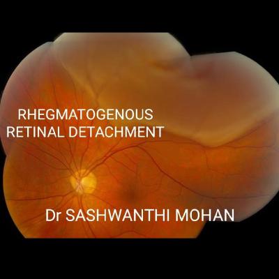 Macula on rhegmatogenous retinal detachment