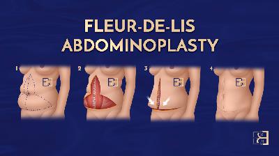 Fleur de Lis Abdominoplasty Following Massive Weight Loss