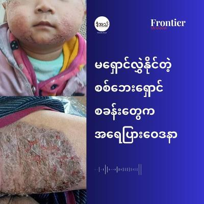 မရှောင်လွှဲနိုင်တဲ့ စစ်ဘေးရှောင်စခန်းတွေက အရေပြားဝေဒနာ