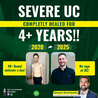 No Ulcerative Colitis Meds or Symptoms for 5 Years No Ulcerative Colitis Meds or Symptoms for 5 Years