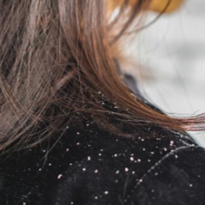 Home Remedies to Cure Dandruff