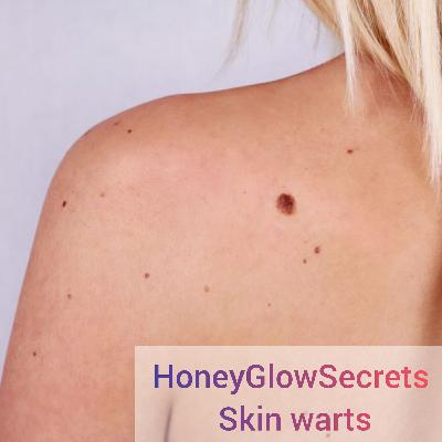 Skintags, moles and warts