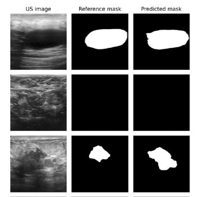 A Deep Dive into Smarter Breast Tumor Detection