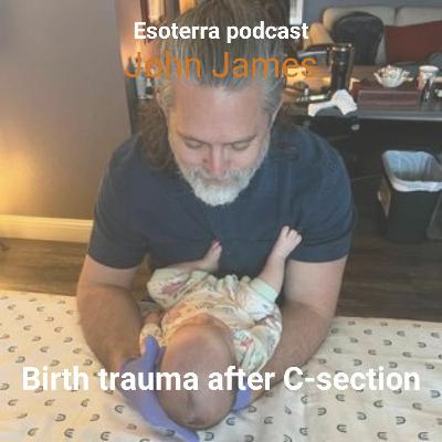 Birth trauma after C-section with John James