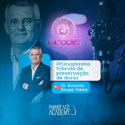 Rinoplastia Híbrida com Preservação de Dorso | Dr. António Sousa Vieira 🇵🇹 Rinoplastia Híbrida com Preservação de Dorso | Dr. António Sousa Vieira 🇵🇹