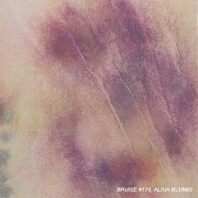 Ep4 Bruises with Alina Bliumis