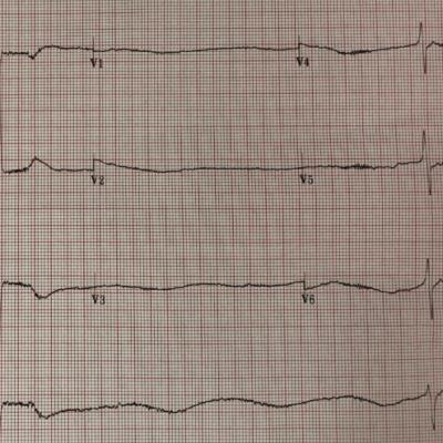 265. Beta Blocker Overdose: There's only one real antidote