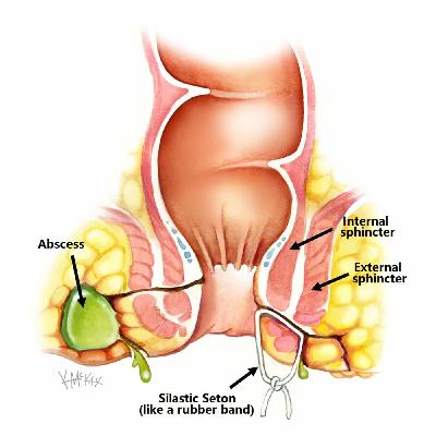 Episode 32: It's Game Time! Management of Fistulizing Crohn's Disease
