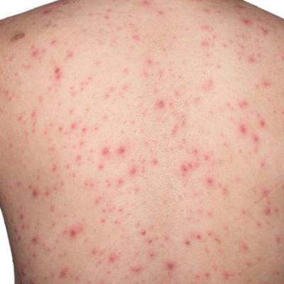 Discover the Difference Between Ecchymosis vs Petechiae