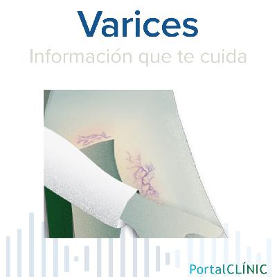 'Las varices son venas que se dilatan' | Varices | Podcast 'Las varices son venas que se dilatan' | Varices | Podcast