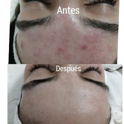 CONSEJO PARA EL CUIDADO DE LA PIEL CON PROBLEMAS DE ACNE