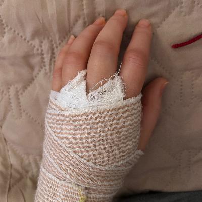 3.9 Help, I'm alive: H is for Hand Surgery 3.9 Help, I'm alive: H is for Hand Surgery