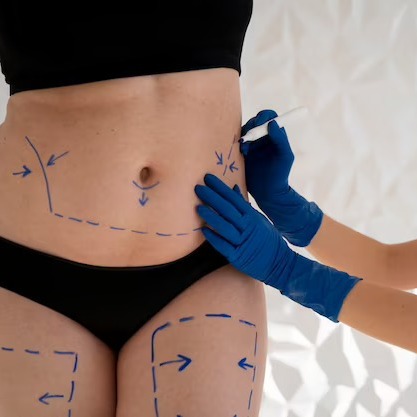 What is the Safest Form of Liposuction? What is the Safest Form of Liposuction?