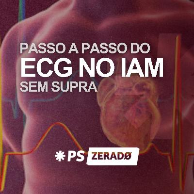 Eletrocardiograma IAMOCA Eletrocardiograma IAMOCA