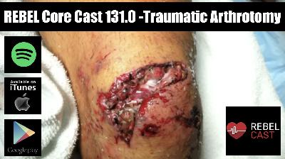 REBEL Core Cast 131.0 - Post-Dural Puncture Headache REBEL Core Cast 131.0 - Post-Dural Puncture Headache