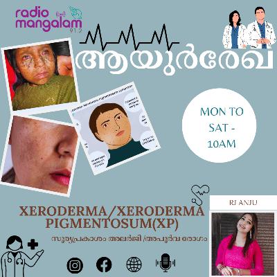 AAYURREKHA- (ആയുർരേഖ)- XERODERMA/XERODERMA PIGMENTOSUM(XP) (സൂര്യപ്രകാശ അലർജി/അപൂർവ രോഗം)EPI 29
