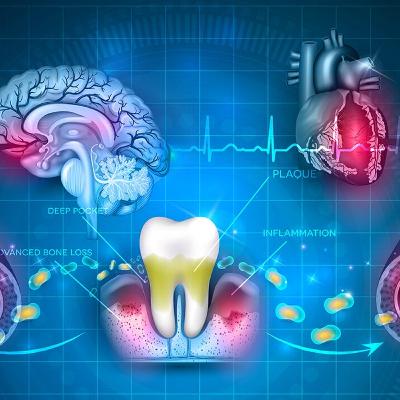 Audio Article: Systematic Review Analyzes the Association Between Periodontal Disease and Stroke
