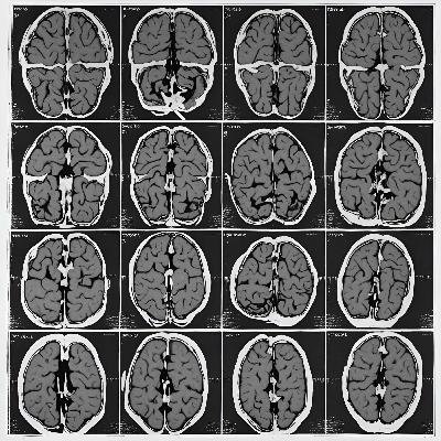 Measuring Neurological Conditions with Dirk Smeets from Icometrix