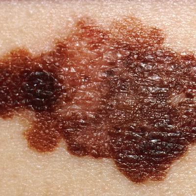 Cáncer cutáneo: ¿cómo podemos realizar una detección precoz?