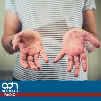 Brote de sarampión se dispara en México