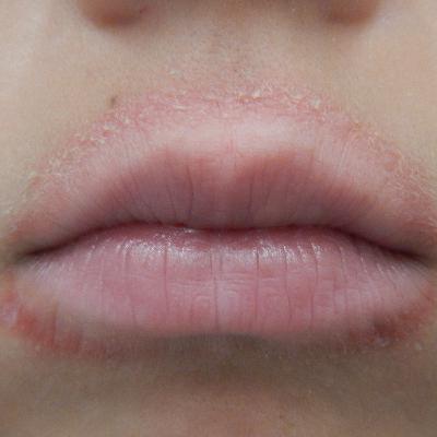 Ep 78: Medical Mysteries: Funky Lip Rash! Ep 78: Medical Mysteries: Funky Lip Rash!