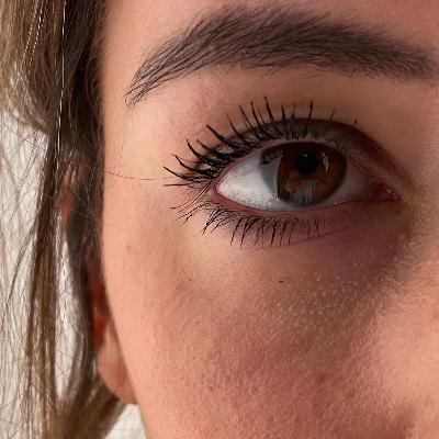 Augenringe Schönheitschirurgie Mc Aesthetics Augenringe Schönheitschirurgie Mc Aesthetics