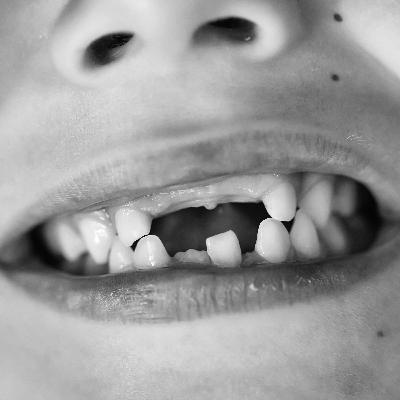 Missing Teeth