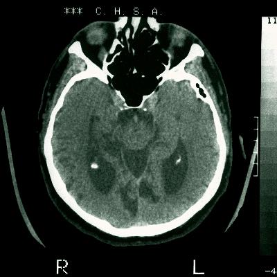 Battling brain rot