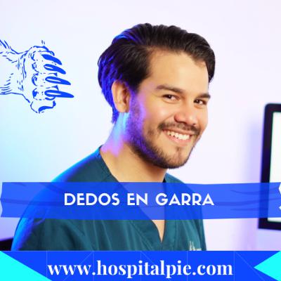 Dedos en Garra. Que es, como prevenirlo y sus tratamientos