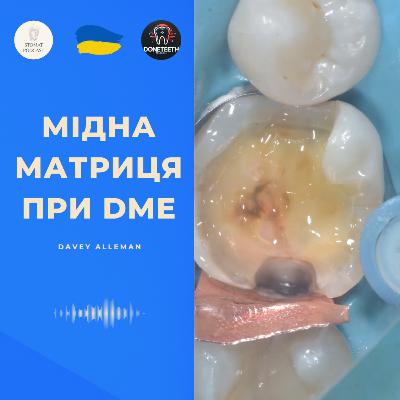 Мідна матриця при DME