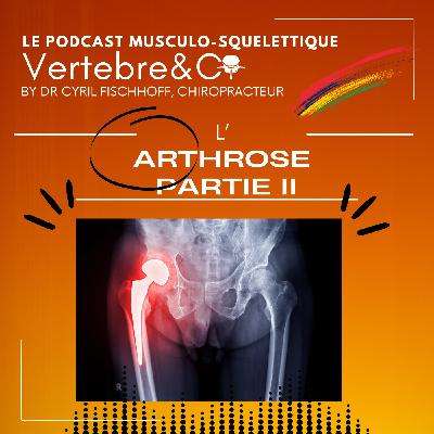 Tout sur l'Arthrose ! (Partie 2) Tout sur l'Arthrose ! (Partie 2)