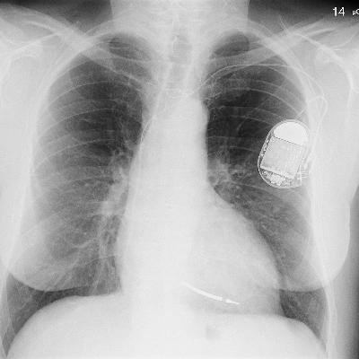 SSM #12: Powering Implanted Medical Devices By James Spicer
